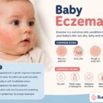 Baby Eczema