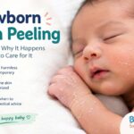 Newborn Skin Peeling